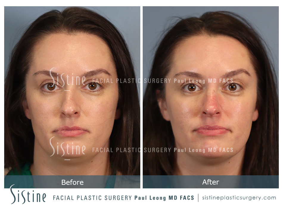 Nose Job Without Surgery - Before Image | Dr. Paul Leong - Pittsburgh PA