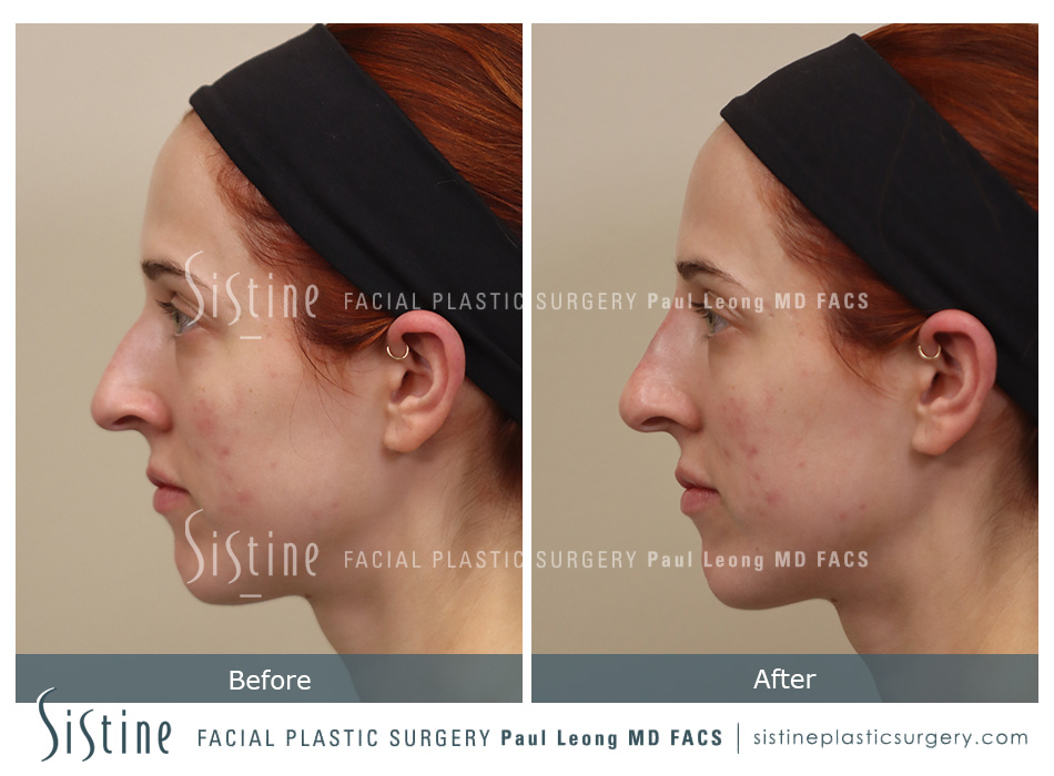 Female Rhinoplasty - Patient Preoperative View | Paul Leong MD