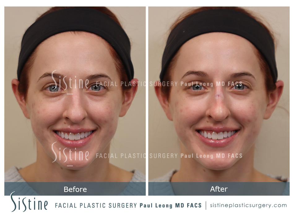 Female Rhinoplasty - Patient Preoperative View | Paul Leong MD