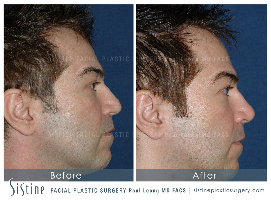 Non Surgical Rhinoplasty Before and After | Sistine Facial Plastic Surgery