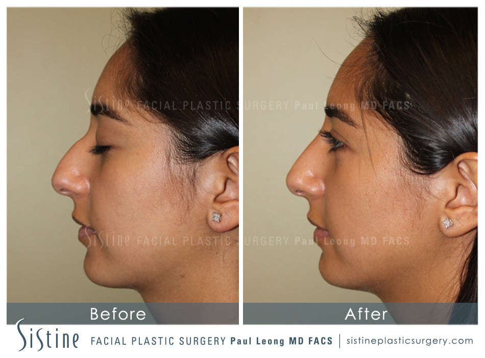 Pittsburgh Non Surgical Rhinoplasty - Before Image | Dr. Paul Leong - Sistine Facial Plastic Surgery