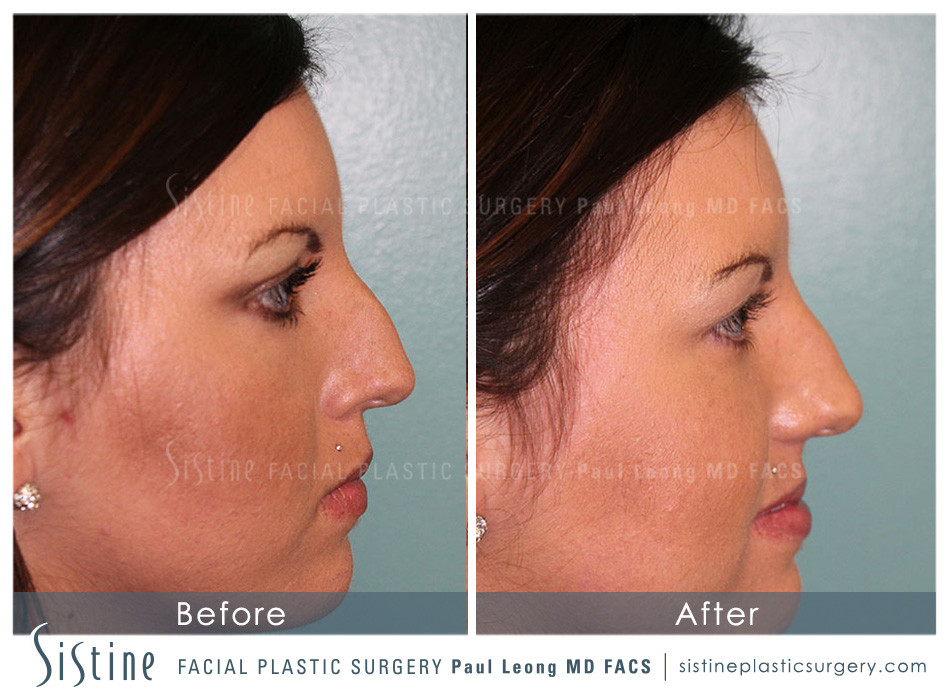 Non-Surgical Rhinoplasty Before Image | Dr. Paul Leong, Pittsburgh PA