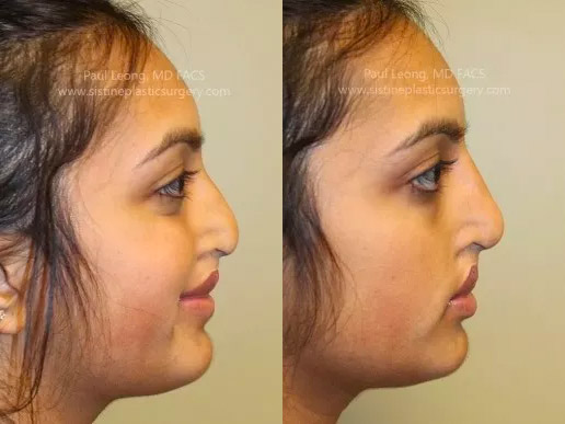 Non-Surgical Nose Job Near Me - Before Image | Paul Leong MD Pittsburgh PA