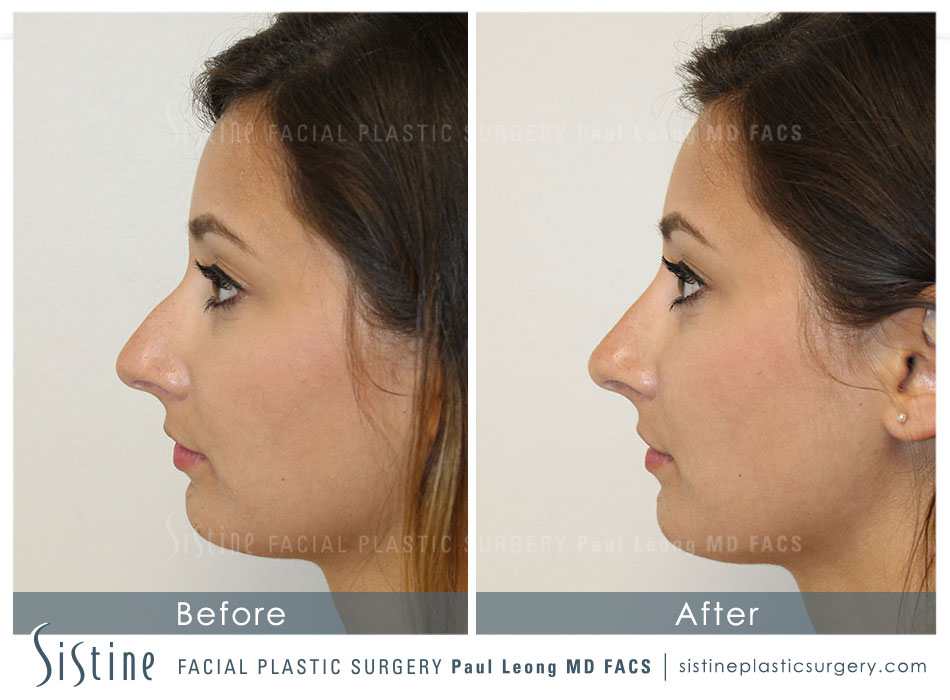 non surgical rhinoplasty, Pittsburgh, PA - Dr. Leong