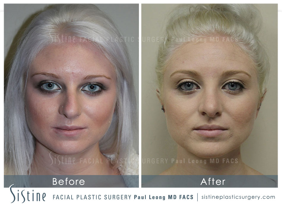 Non Surgical Rhinoplasty Before and After | Sistine Facial Plastic Surgery