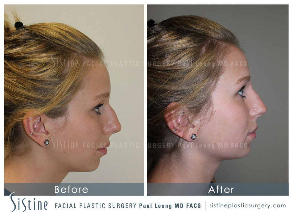 Pittsburgh PA Non-Surgical Rhinoplasty - Before Image | Dr. Paul Leong at Sistine Facial Plastic Surgery