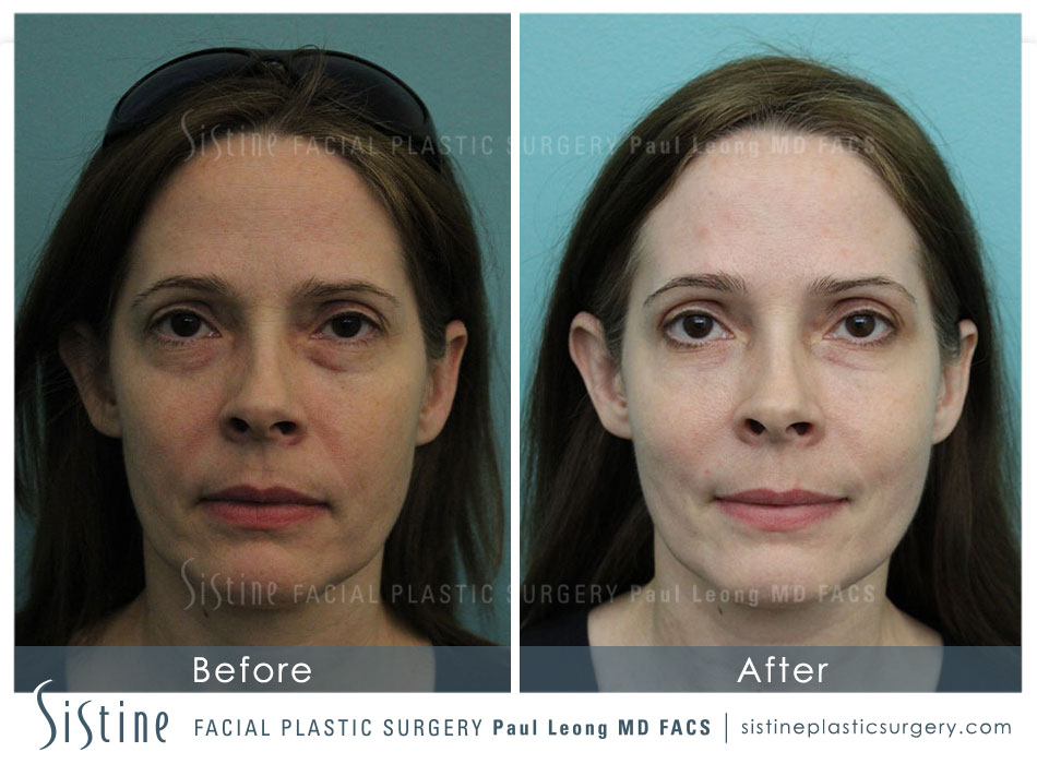 Sculptra Before and After Sistine Facial Plastic Surgery