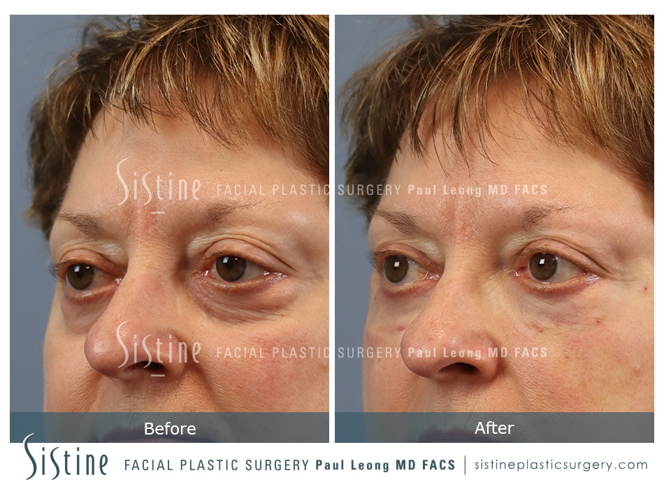 Tear Trough Correction Before and After | Sistine Facial Plastic Surgery