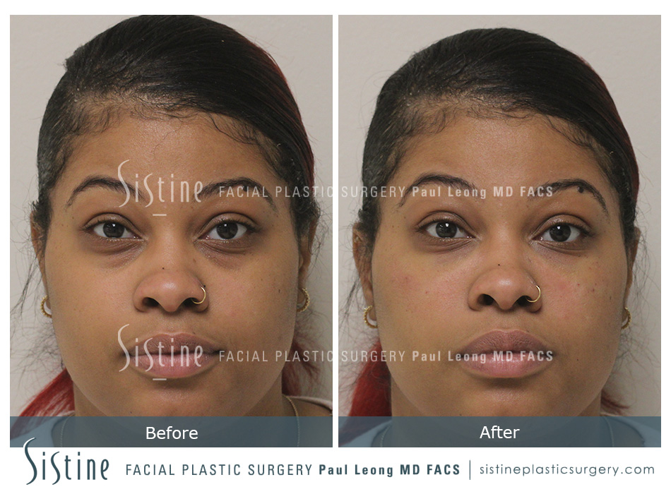 Tear Trough Treatment with Restylane - Before Photo | Sistine Facial Plastic Surgery