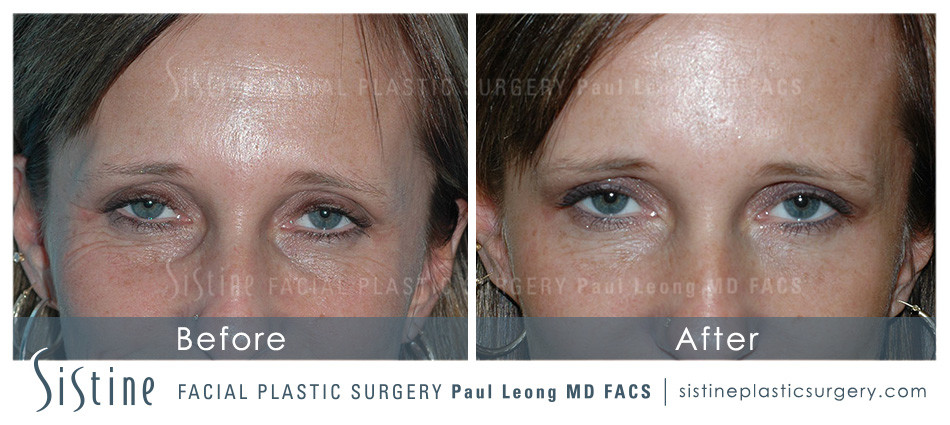Restylane Injection Tear Trough - Before Image | Sistine Facial Plastic Surgery - Pittbsurgh PA