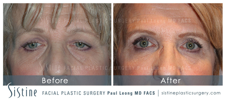 Tear Trough Fillers - Before Treatment | Sistine Facial Plastic Surgery - Sewickley PA