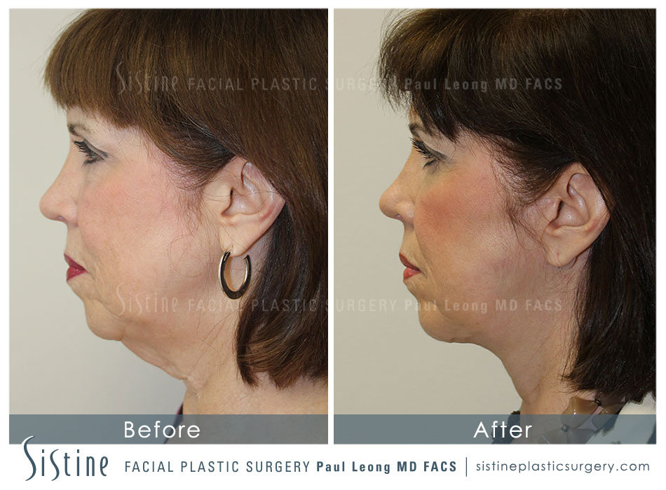 SMAS Face and Neck Lift Pittsburgh - Preoperative Right Lateral View | Dr. Paul Leong