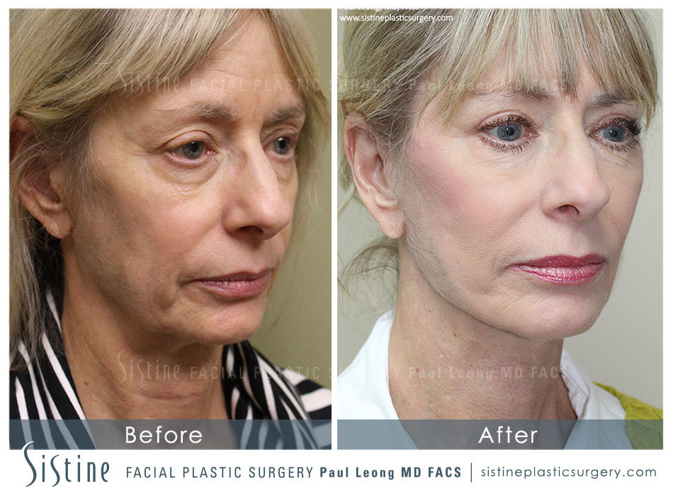 Before Eyelid Lift in Pittsburgh - Before Image | Dr. Paul Leong