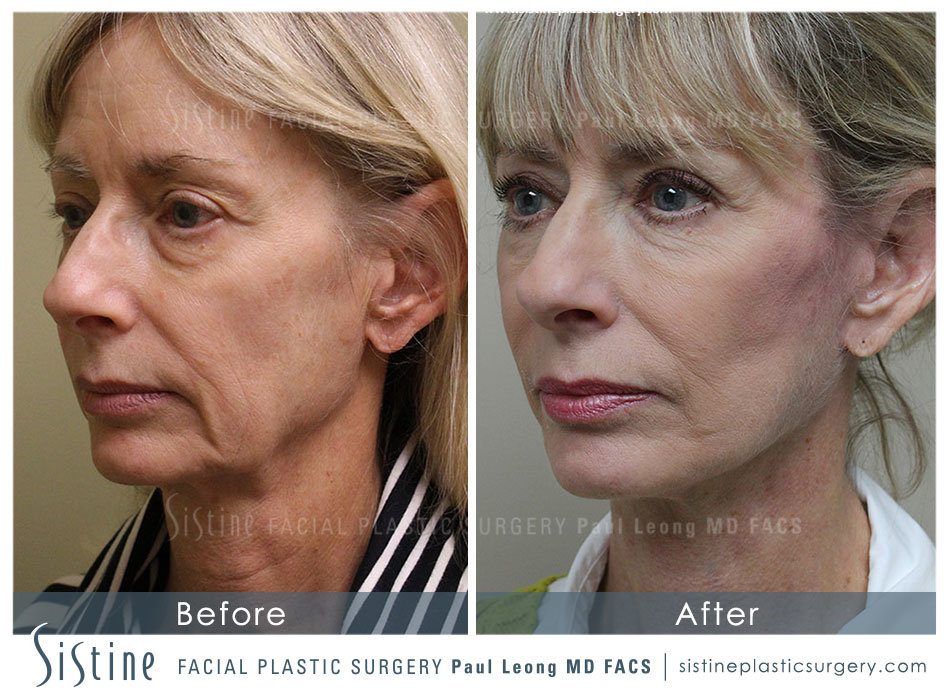 Deep Plane Facelift in Pittsburgh - Preoperative Side View | Dr. Paul Leong