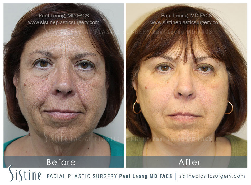 Tear Trough Correction Before and After | Sistine Facial Plastic Surgery