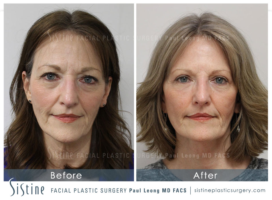 Pittsburgh Mens Facelift - Before Image | Sistine Facial Plastic Surgery