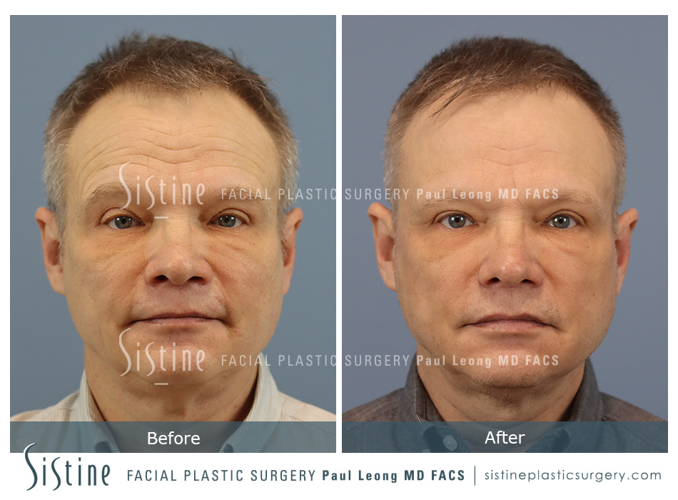 Cortex™ CO2/Erbium Yag Laser - Before Image | Sistine Facial Plastic Surgery