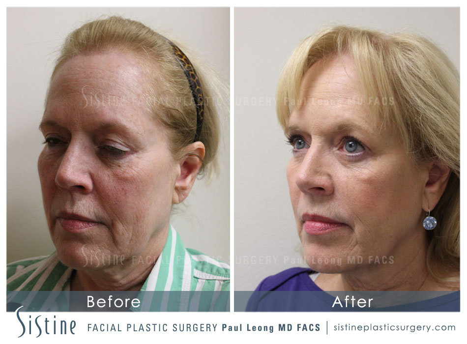 Cortex Co2 Erbium Yag Laser Before and After | Sistine Facial Plastic Surgery