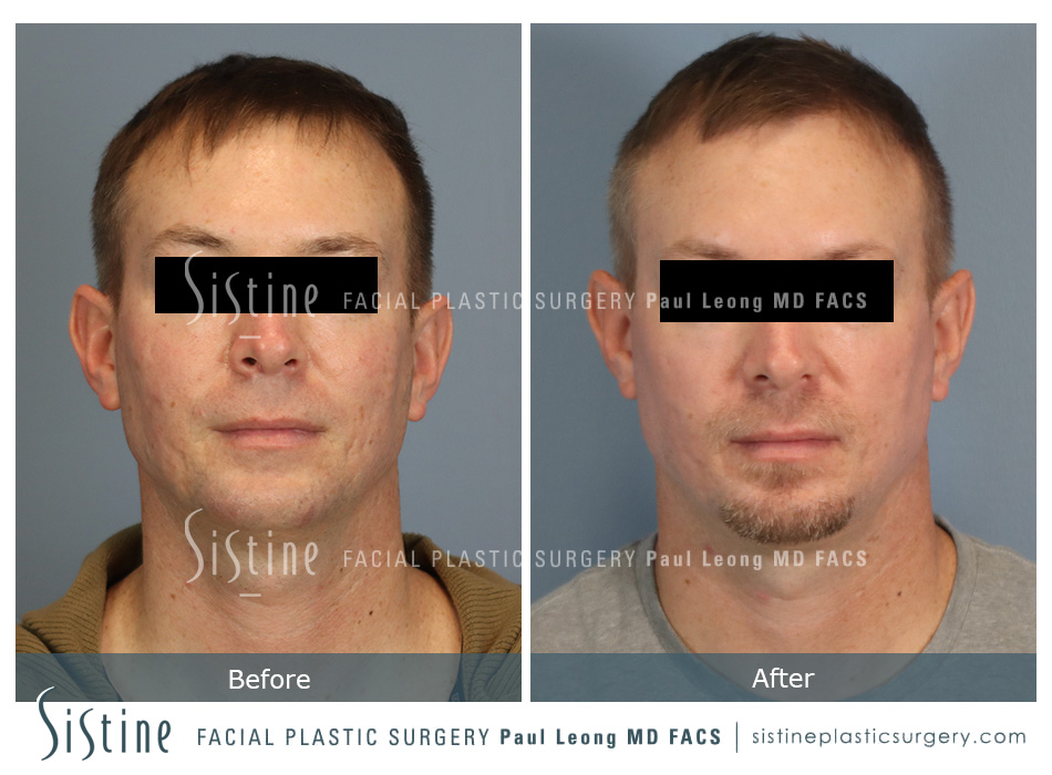 Cortex Co2 Laser Before and After | Sistine Facial Plastic Surgery