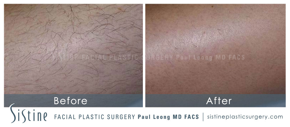Laser Hair Removal Before and After | Sistine Facial Plastic Surgery