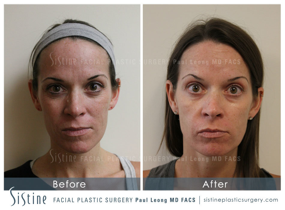 Phoenix Co2 Before and After | Sistine Facial Plastic Surgery