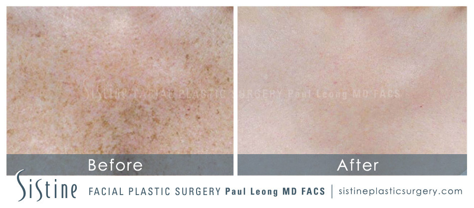 IPL Photofacials for Freckles - Before Image | Sistine Facial Plastic Surgery, Pittsburgh PA 