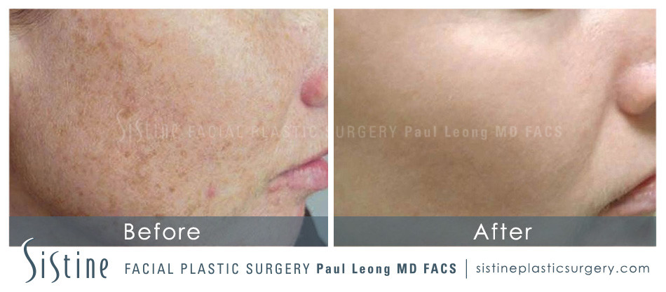 IPL Freckle Removal - Before Image | Dr. Paul Leong, Pittsburgh PA