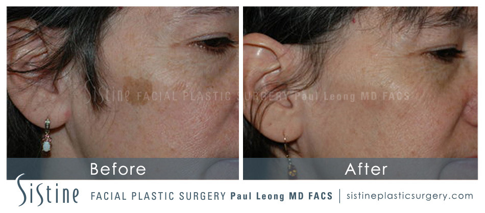 IPL Laser Before Image | Dr. Paul Leong, Pittsburgh PA