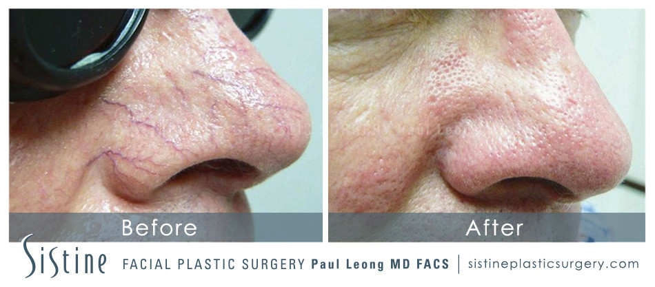Pittsburgh IPL Treatments - Before Images | Paul Leong MD