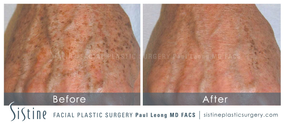 Photorejuvenation IPL - Before Image | Sistine Facial Plastic Surgery, Pittsburgh PA