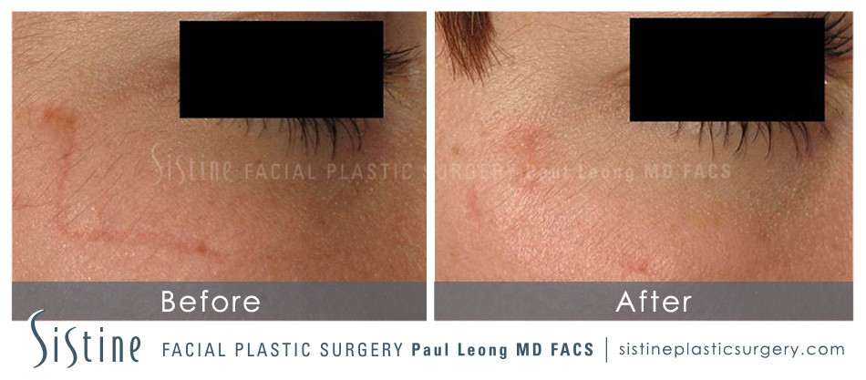 Scar Wrinkle Removal Before and After | Sistine Facial Plastic Surgery
