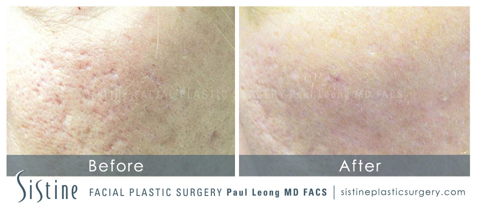 Laser Acne Scar Removal - Before Image | Dr. Paul Leong - Southside Works Pittsburgh 