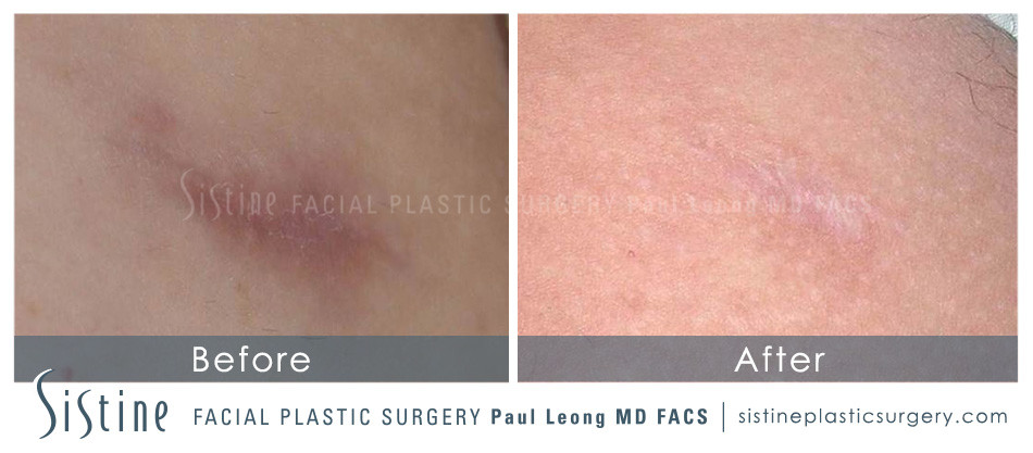 Laser Treatments for Scars - Before Image | Paul Leong MD, Wexford PA