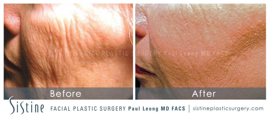 Pittsburgh PA Laser Wrinkle Removal - Before Image | Dr. Paul Leong