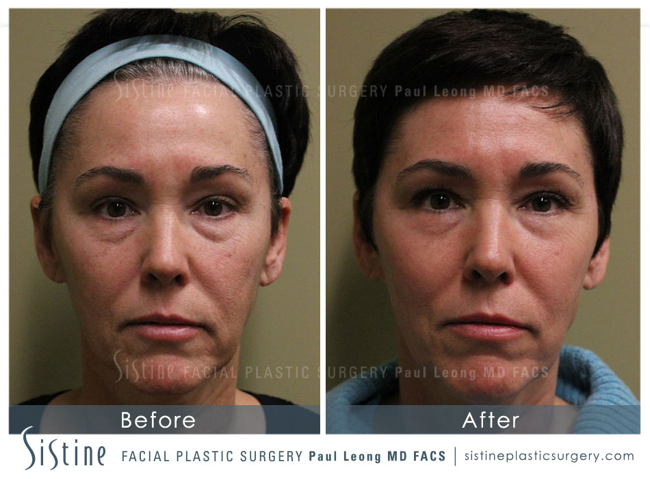 Scar Wrinkle Removal Before and After | Sistine Facial Plastic Surgery