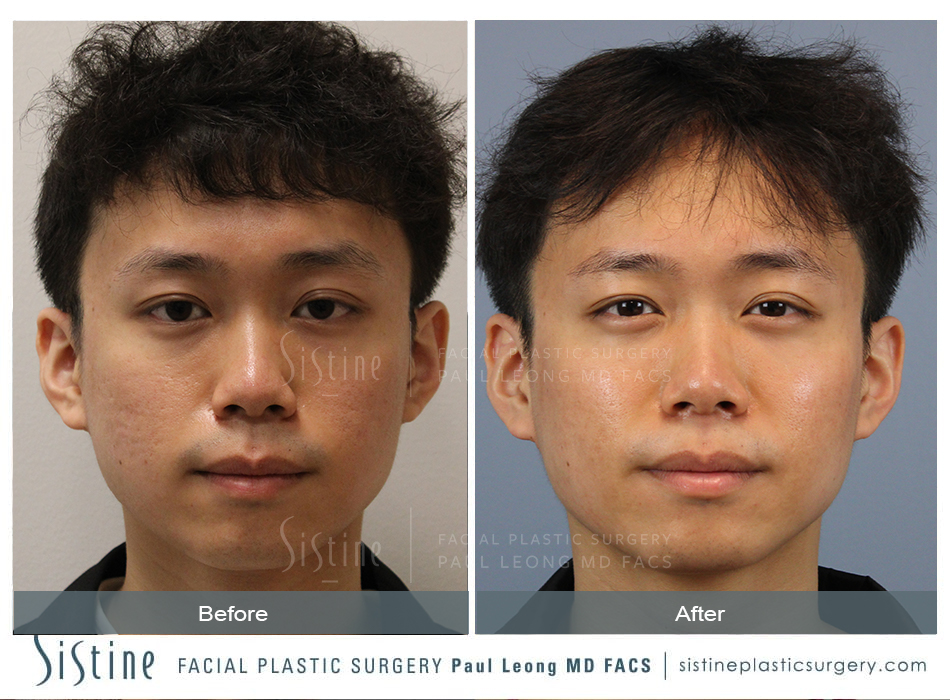 Skinpen Microneedling Before and After | Sistine Facial Plastic Surgery