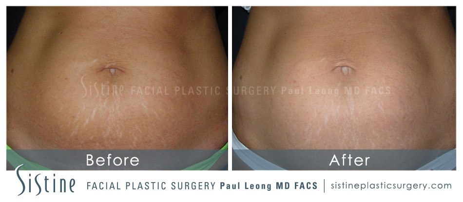 Stretch Marks Before and After | Sistine Facial Plastic Surgery