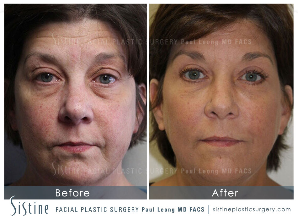Ultherapy Before and After | Sistine Facial Plastic Surgery