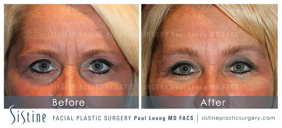 Brow And Forehead Before and After | Sistine Facial Plastic Surgery