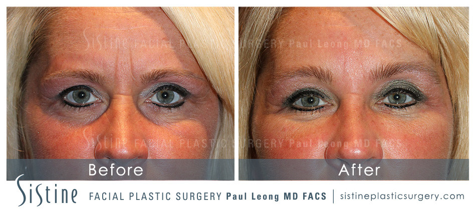 ﻿Restylane® Filler for Tear Troughs in Pittsburgh, PA - Before Photos | Sistine Facial Plastic Surgery 