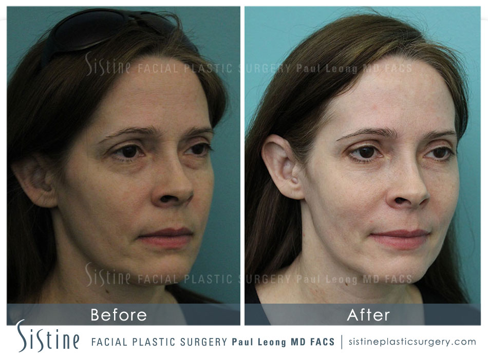 Cheeks Before and After | Sistine Facial Plastic Surgery