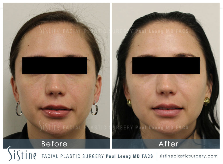 Cheeks Before and After | Sistine Facial Plastic Surgery