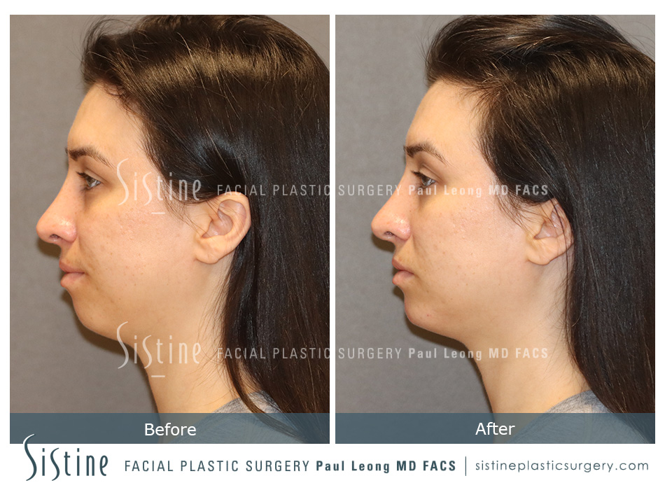 Highland Park Pittsburgh Non-Surgical Rhinoplasty - Before | Dr. Paul Leong - Sistine Facial Plastic Surgery