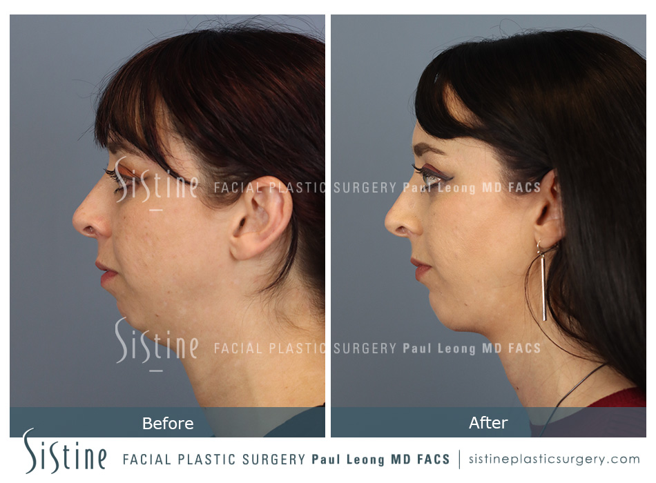 Pittsburgh High SMAS Facelift - Preoperative Left Oblique View | Sistine Facial Plastic Surgery