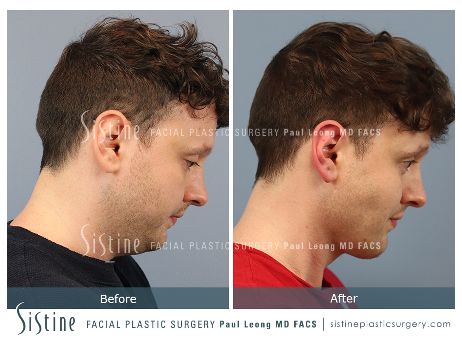 Chin Jaw And Neck Before and After | Sistine Facial Plastic Surgery
