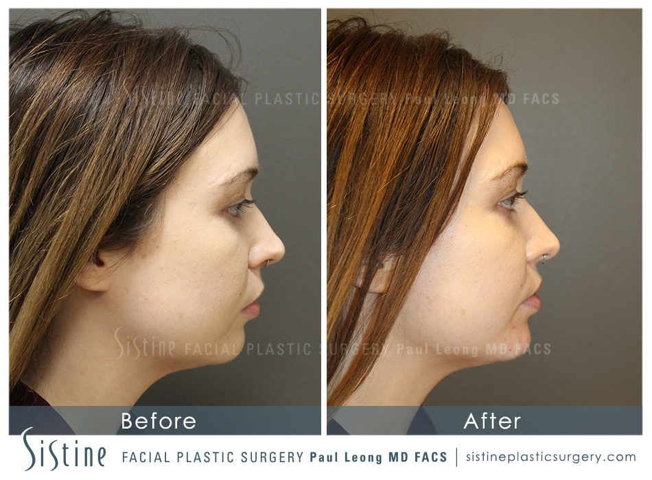 Chin Jaw And Neck Before and After 02 Sistine Facial