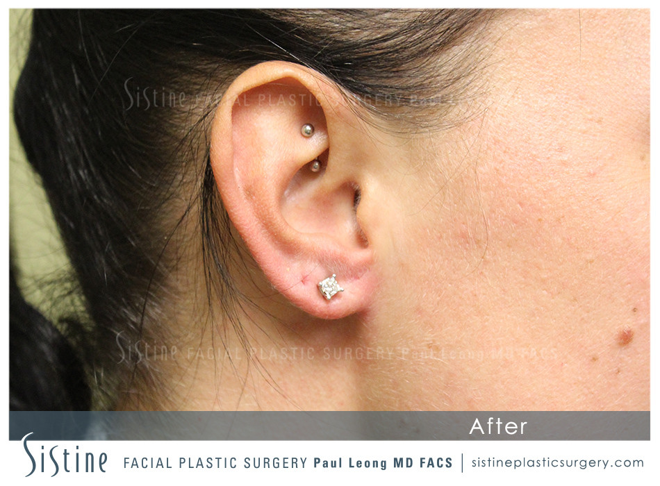 Repierced gauged earlobe repair pittsburgh, pa