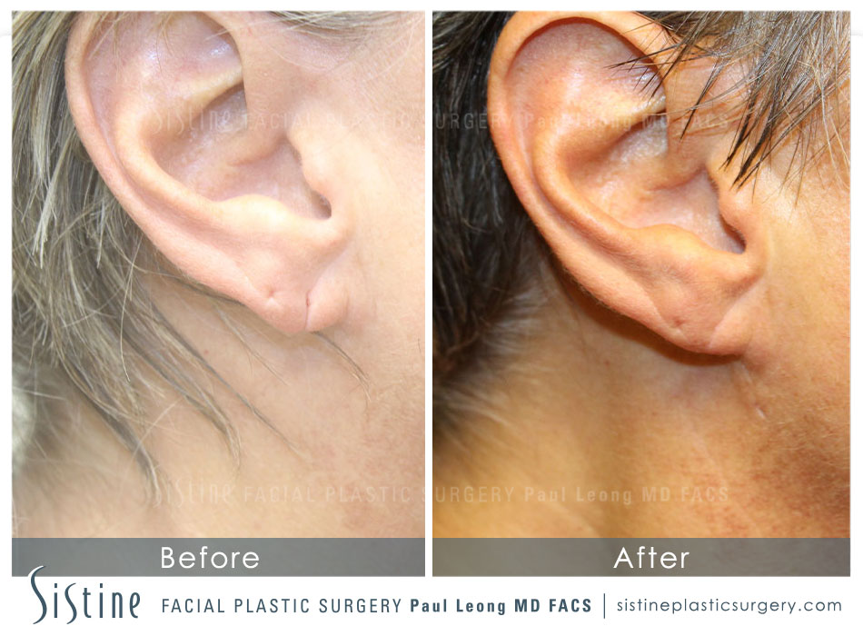 Ears Before and After | Sistine Facial Plastic Surgery