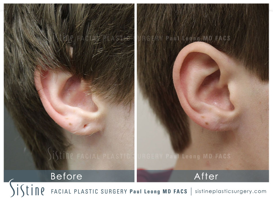 Ears Before and After | Sistine Facial Plastic Surgery