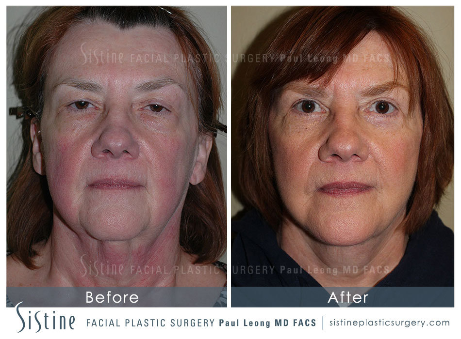 Pittsburgh Face and Neck Lift - Frontal Preoperative View | Sistine Facial Plastic Surgery 